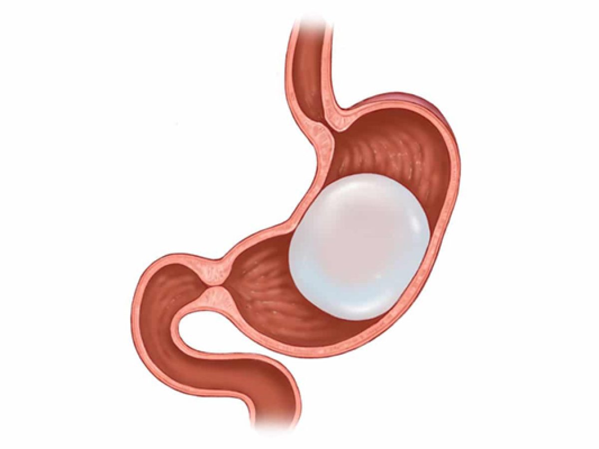 Gastric Balloon in Dubai